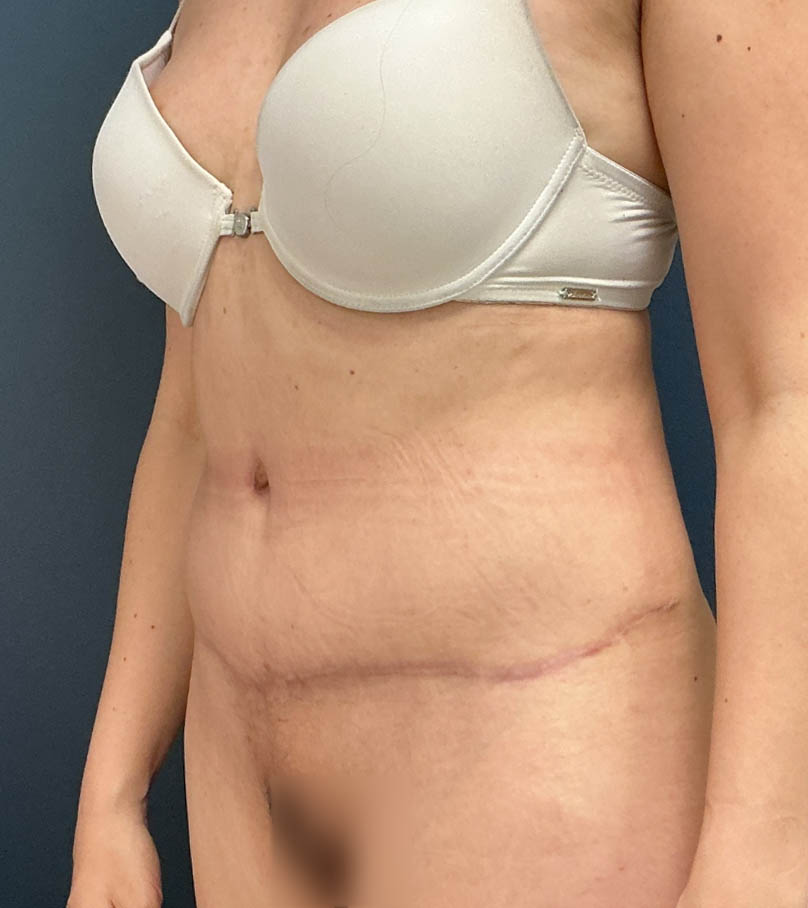 Tummy Tuck case #20571