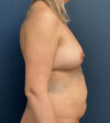 Breast Augmentation With Lift case #20496