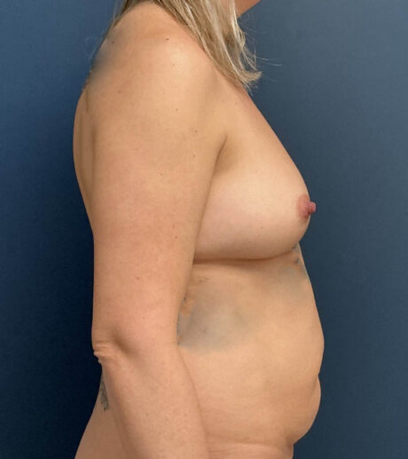 Breast Augmentation With Lift case #20496