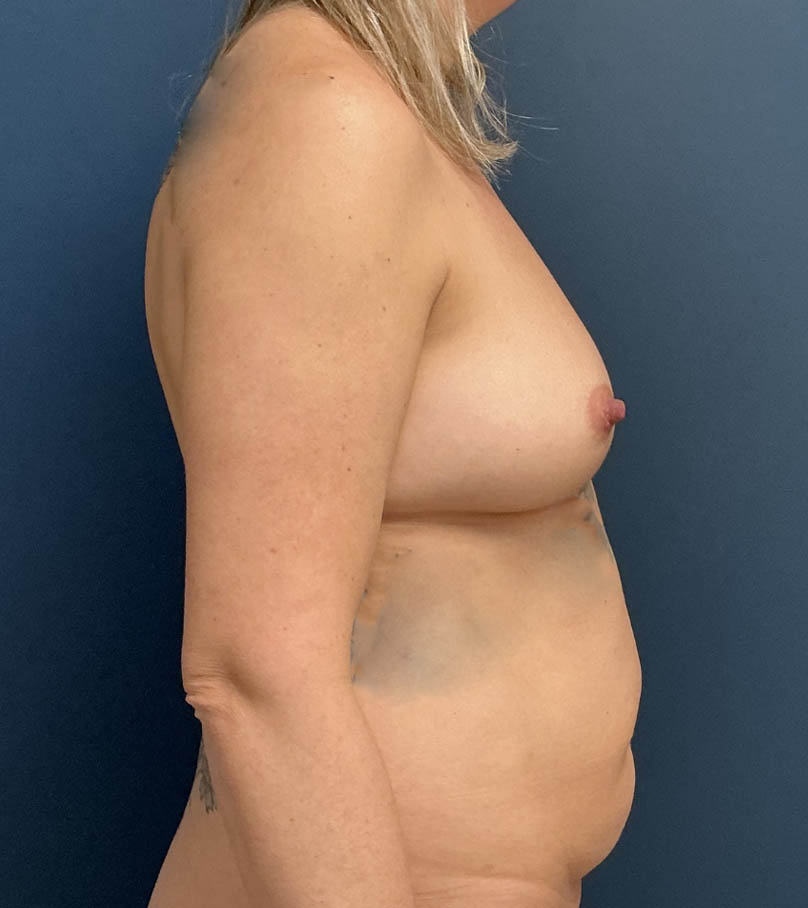 Breast Augmentation With Lift case #20496