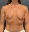 Breast Augmentation case #20483