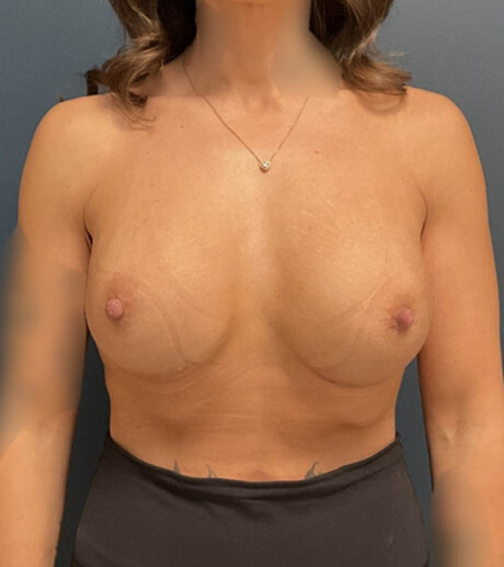Breast Augmentation case #20483