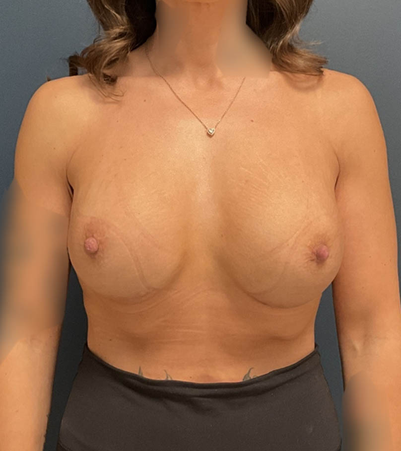 Breast Augmentation case #20483