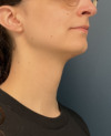 Facial Feminization Surgery case #20537