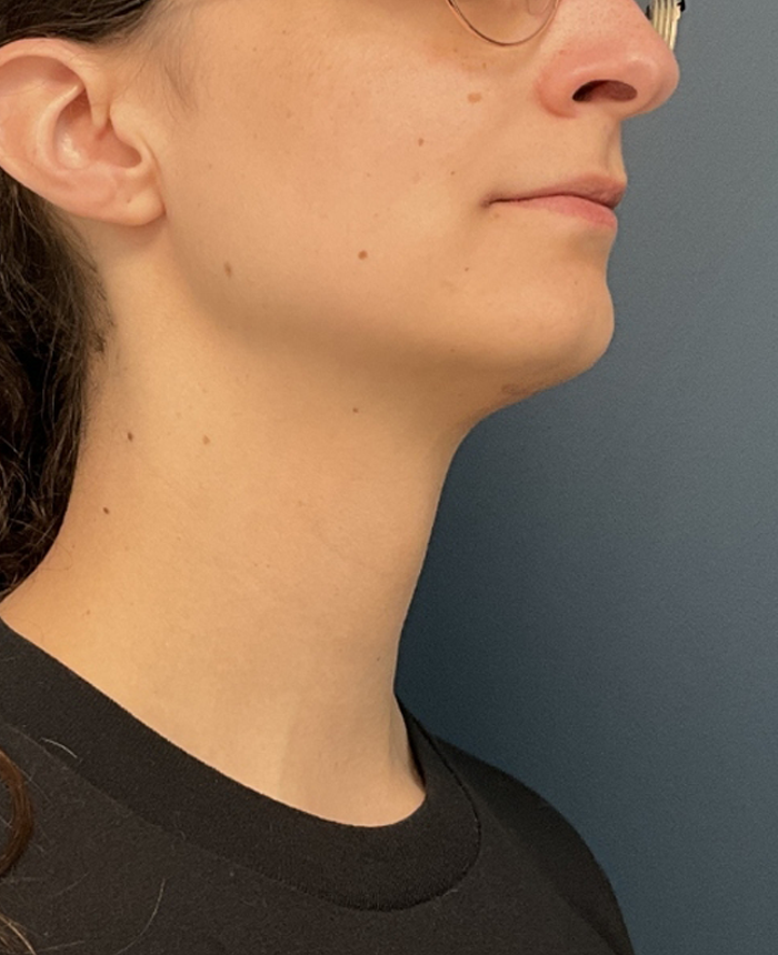 Facial Feminization Surgery case #20537