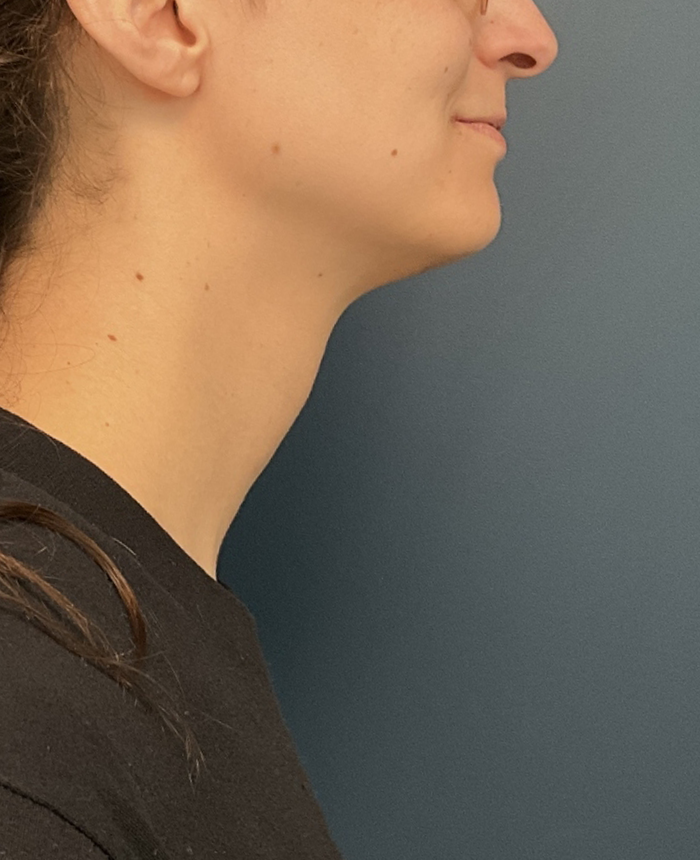Facial Feminization Surgery case #20537