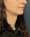 Facial Feminization Surgery case #20537
