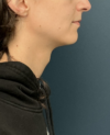 Facial Feminization Surgery case #20537