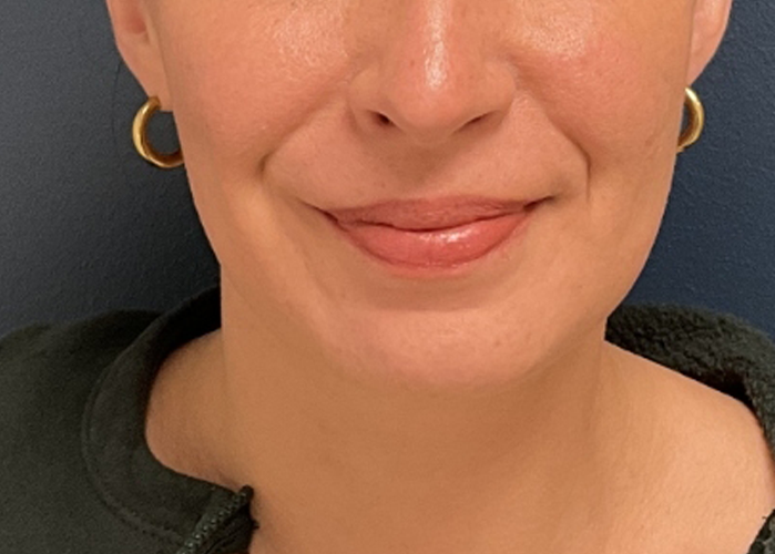 Chin Liposuction case #20529