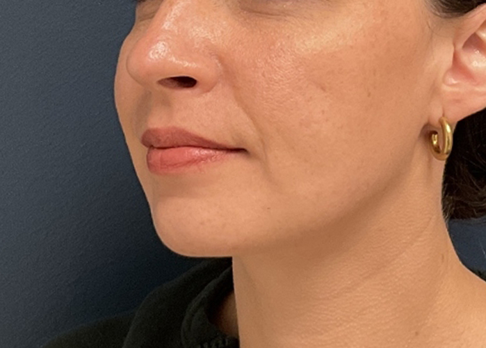 Chin Liposuction case #20529