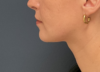 Chin Liposuction case #20529