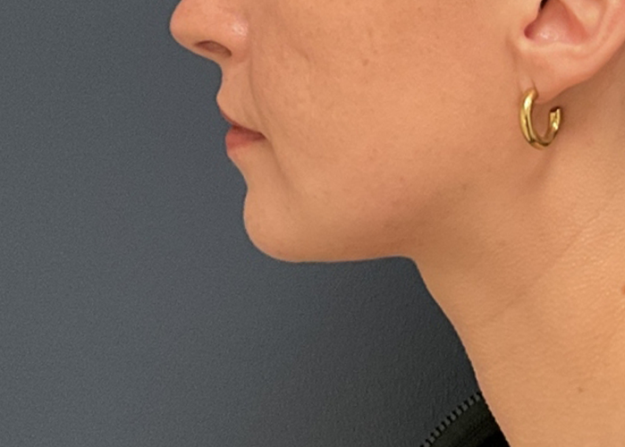 Chin Liposuction case #20529