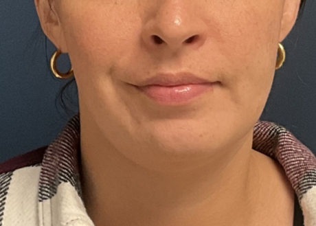 Chin Liposuction case #20529