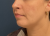 Chin Liposuction case #20529