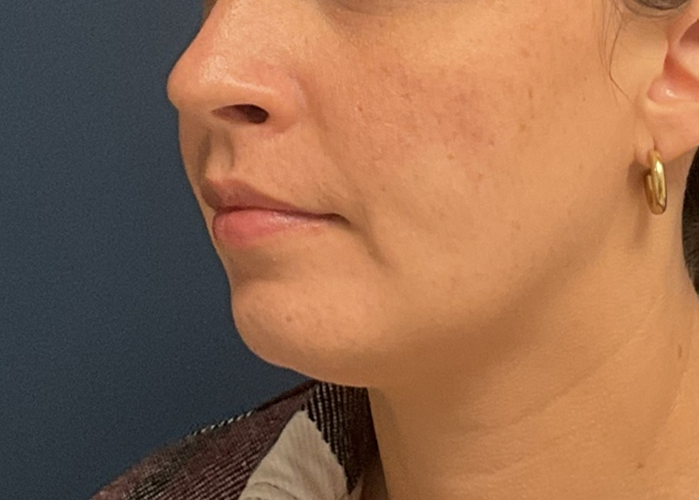 Chin Liposuction case #20529