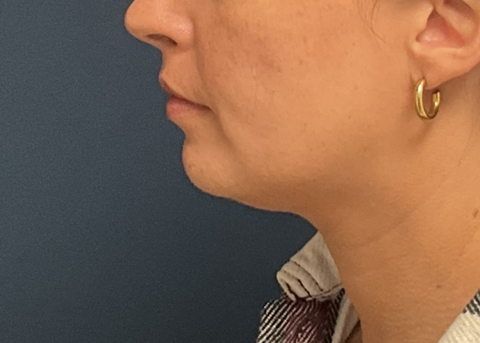 Chin Liposuction case #20529
