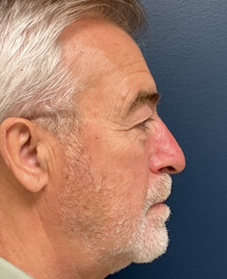 Eyelid Surgery case #20543