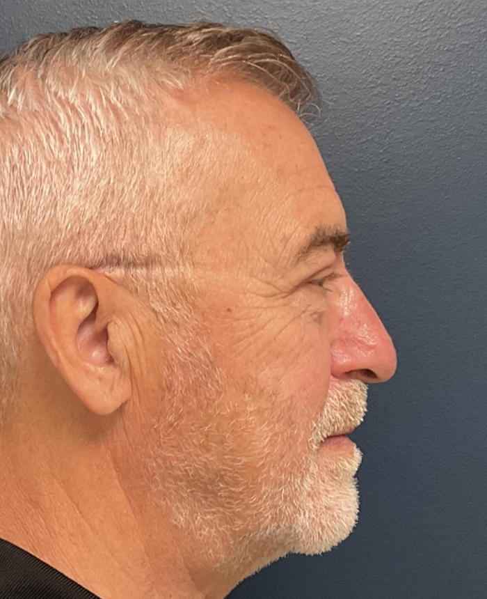 Eyelid Surgery case #20543