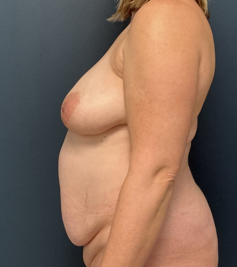 Breast Lift case #20509