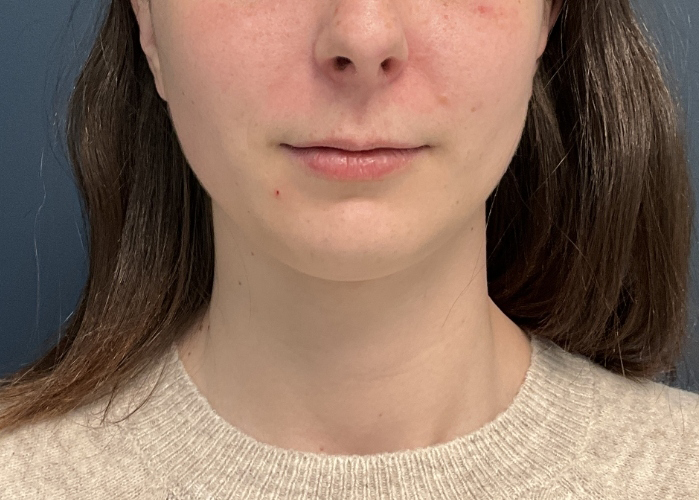 Chin Liposuction case #20520