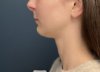 Chin Liposuction case #20520