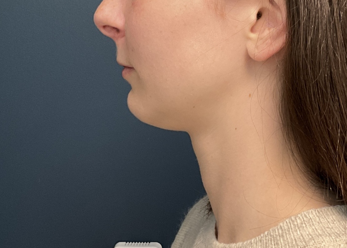 Chin Liposuction case #20520