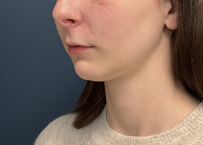 Chin Liposuction case #20520