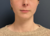 Chin Liposuction case #20520