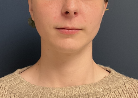 Chin Liposuction case #20520