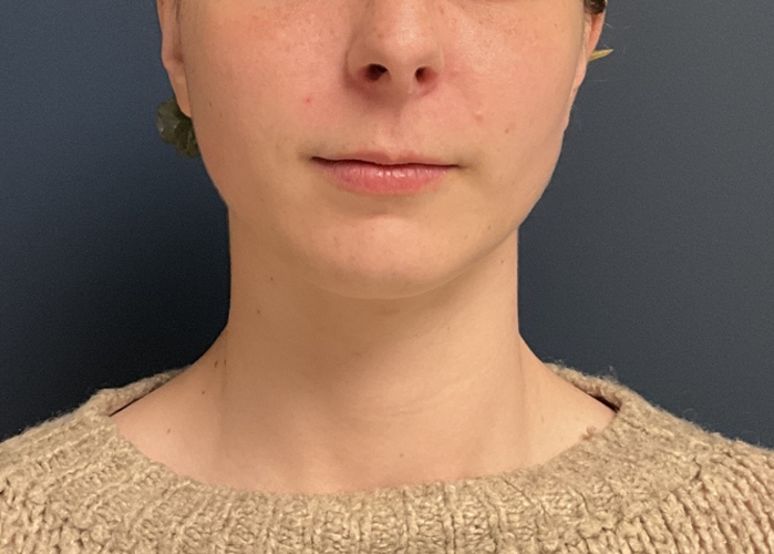 Chin Liposuction case #20520