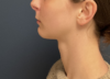 Chin Liposuction case #20520