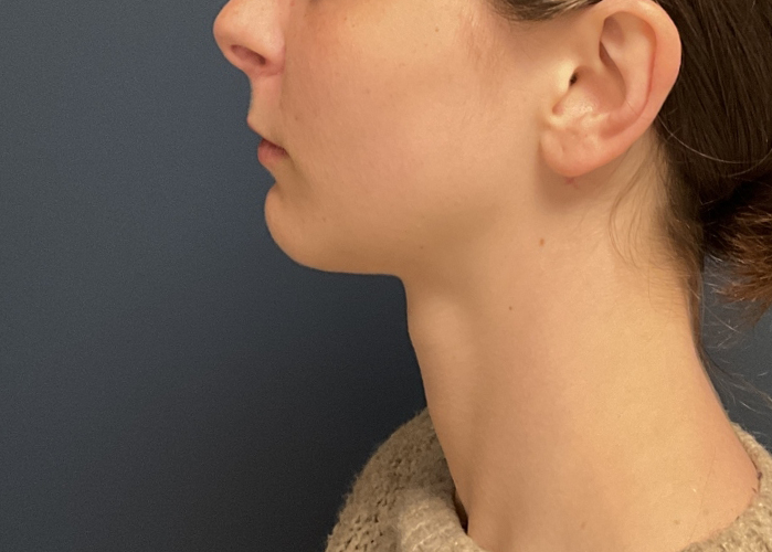 Chin Liposuction case #20520