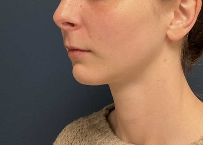 Chin Liposuction case #20520