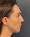 Rhinoplasty case #20963