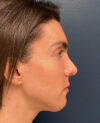 Rhinoplasty case #20963