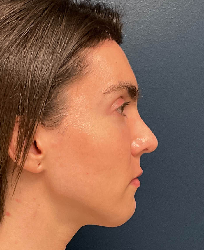 Rhinoplasty case #20963