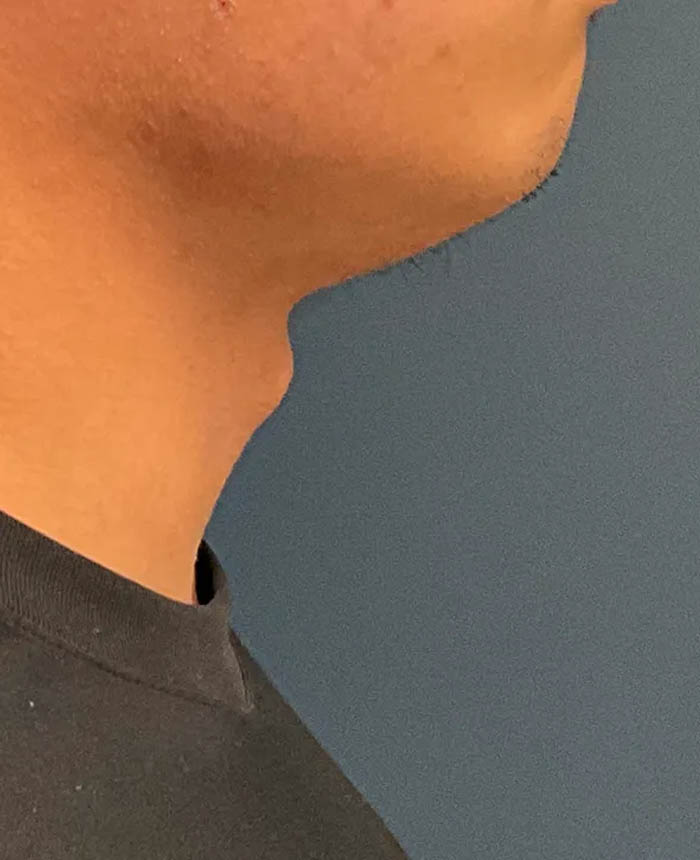 Gender Affirming Surgery case #20985