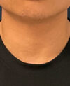 Gender Affirming Surgery case #20985