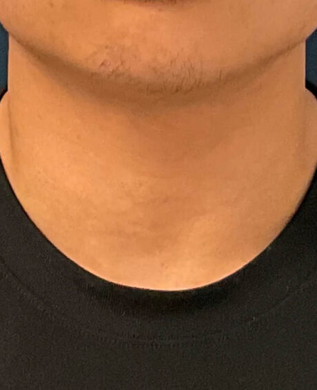 Gender Affirming Surgery case #20985