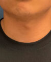 Gender Affirming Surgery case #20985