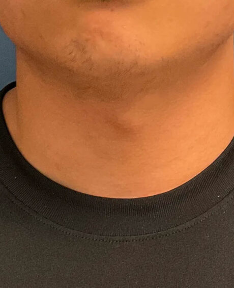 Gender Affirming Surgery case #20985