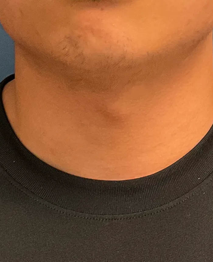 Gender Affirming Surgery case #20985