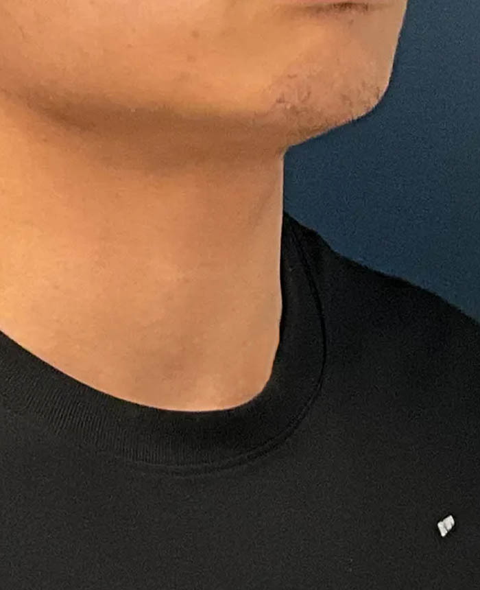 Gender Affirming Surgery case #20985