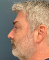 Eyelid Surgery case #20955