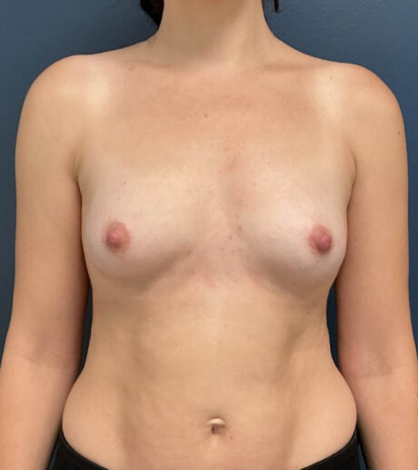 Breast Augmentation case #20906