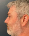 Eyelid Surgery case #20955