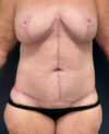 Lower Body Lift case #20995