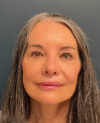 Eyelid Surgery case #20975
