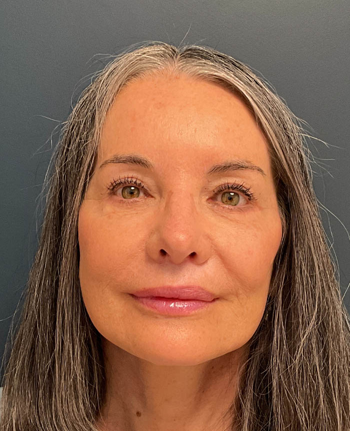 Eyelid Surgery case #20975