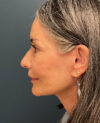 Eyelid Surgery case #20975